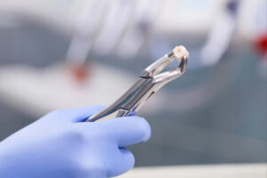 woodcrest tooth extraction