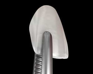 riverside veneers
