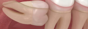 riverside wisdom tooth extraction