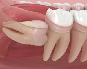 riverside wisdom tooth extraction